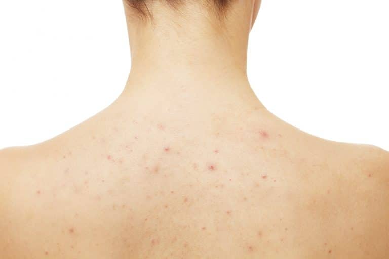 13-really-easy-ways-to-get-rid-of-shoulder-acne