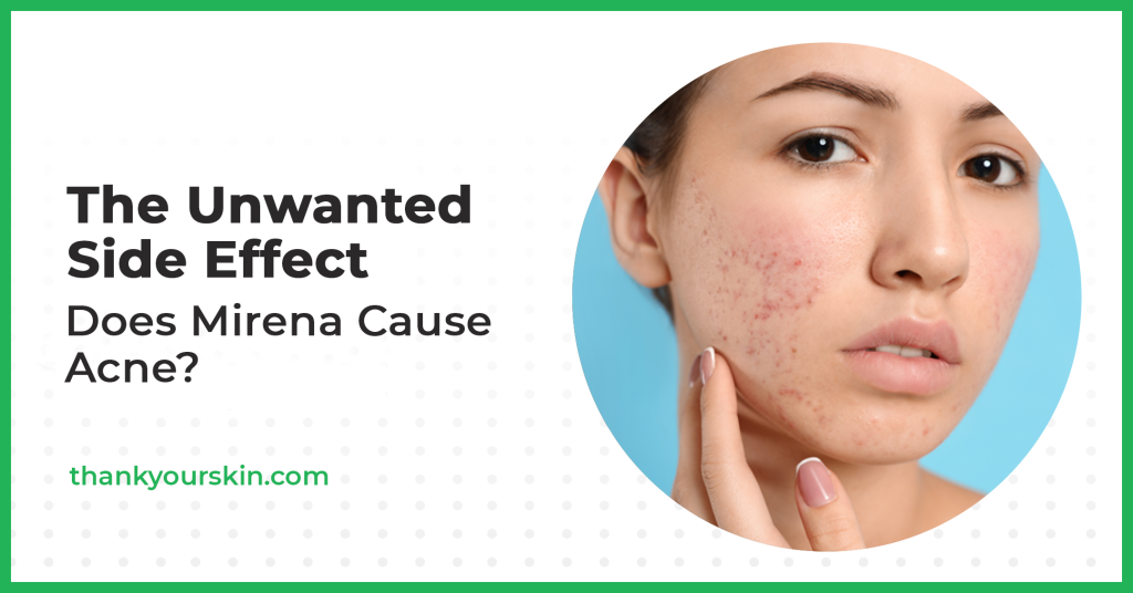 Does Mirena Cause Acne? (Read This Before Getting Your IUD)
